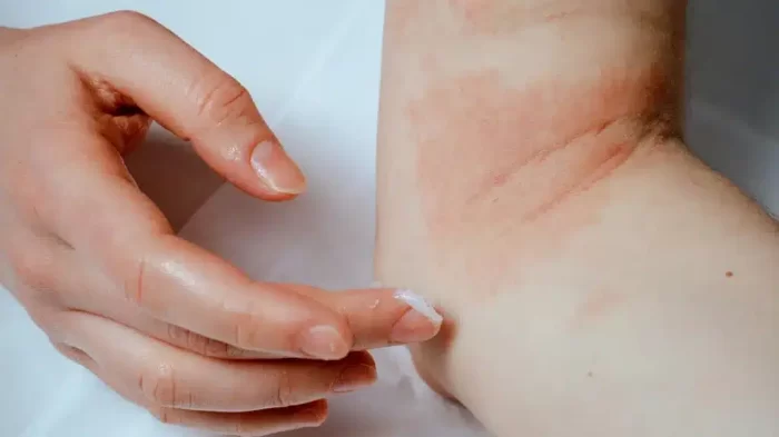 Eczema | Dermatitis, Everything You Need To Know.