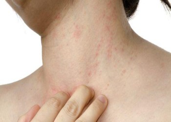 Eczema-Dermatitis is a condition which affects the skin which can affect anyone.