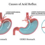 Acid Reflux, Their Most Common Symptom