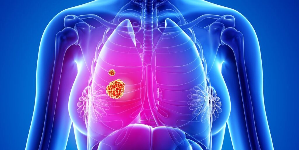 Lung Cancer, New study suggests proton therapy for heart disease